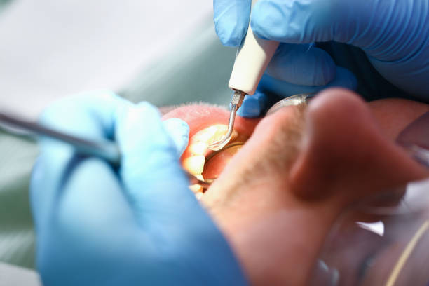 Best Emergency Dental Extractions in Laurel Hill, VA